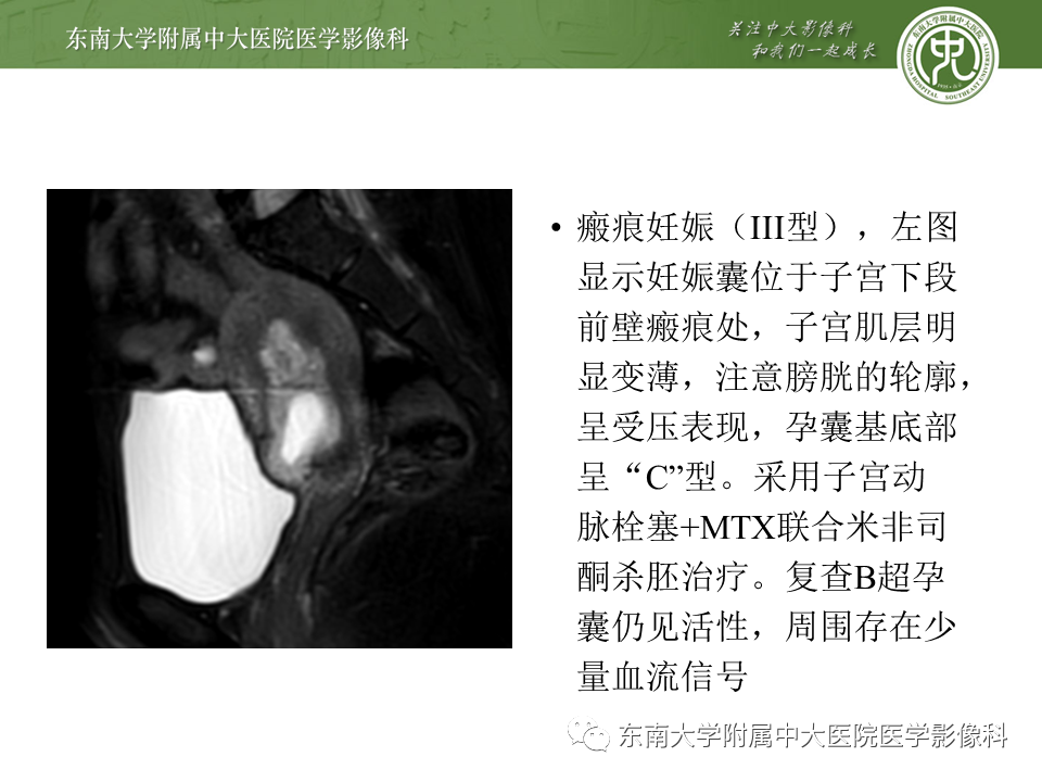 影像PPT - 【PPT】剖宫产瘢痕妊娠-21
