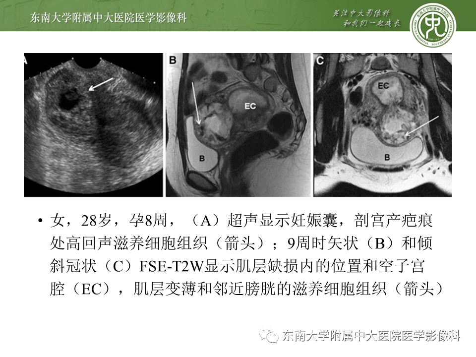 影像PPT - 【PPT】剖宫产瘢痕妊娠-22