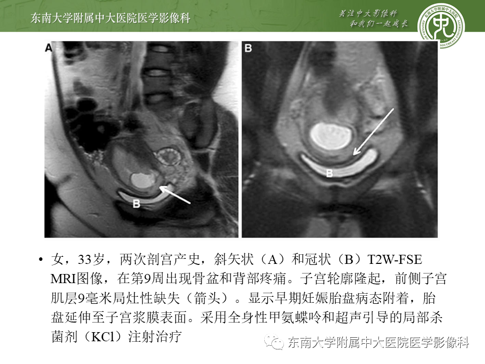 影像PPT - 【PPT】剖宫产瘢痕妊娠-23