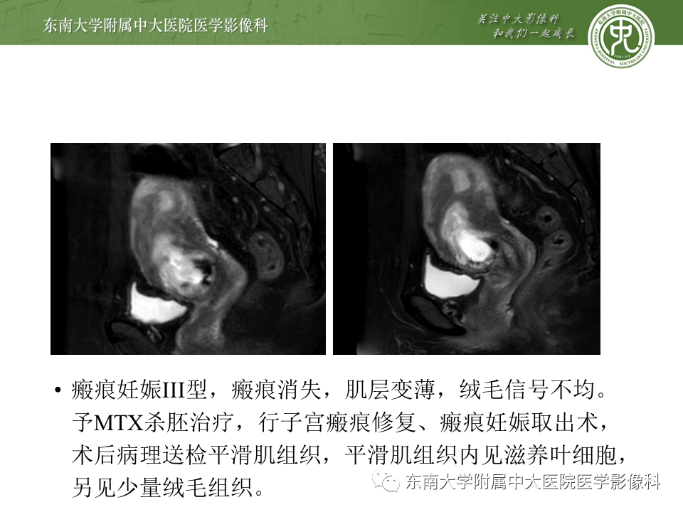 影像PPT - 【PPT】剖宫产瘢痕妊娠-25