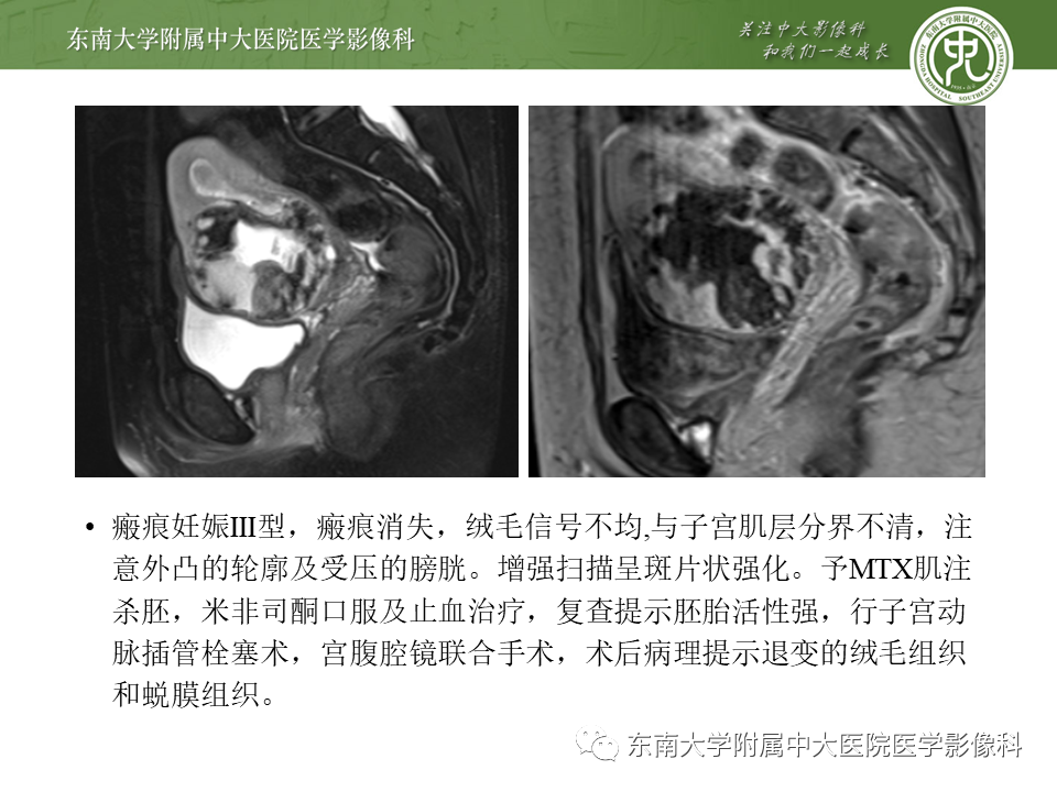 影像PPT - 【PPT】剖宫产瘢痕妊娠-26