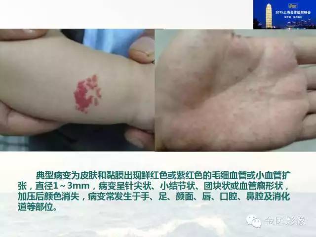 影像PPT - 【PPT】遗传性毛细血管扩张症的临床及影像诊断-4