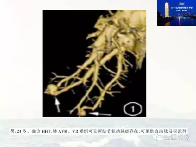 影像PPT - 【PPT】遗传性毛细血管扩张症的临床及影像诊断-8