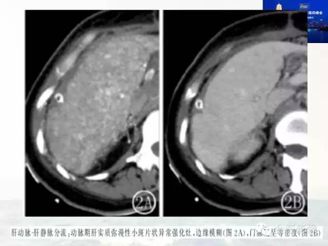 影像PPT - 【PPT】遗传性毛细血管扩张症的临床及影像诊断-10