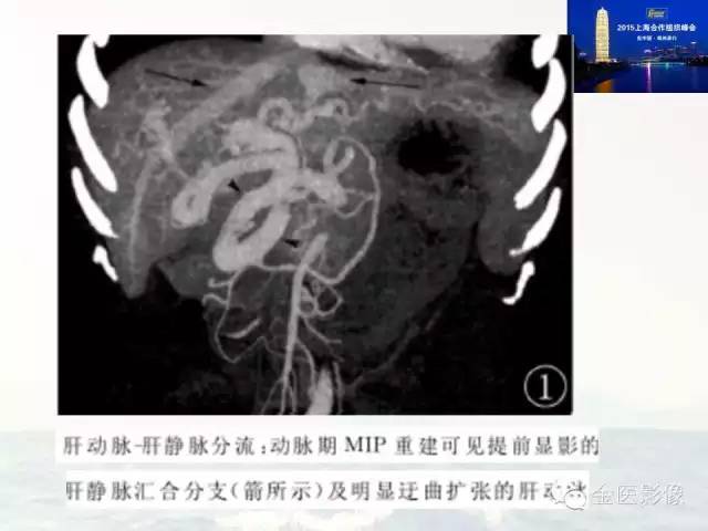 影像PPT - 【PPT】遗传性毛细血管扩张症的临床及影像诊断-11