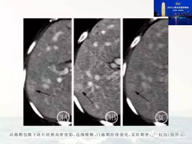 影像PPT - 【PPT】遗传性毛细血管扩张症的临床及影像诊断-12