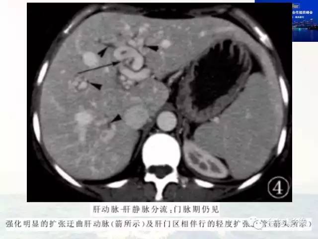 影像PPT - 【PPT】遗传性毛细血管扩张症的临床及影像诊断-13