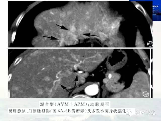 影像PPT - 【PPT】遗传性毛细血管扩张症的临床及影像诊断-15