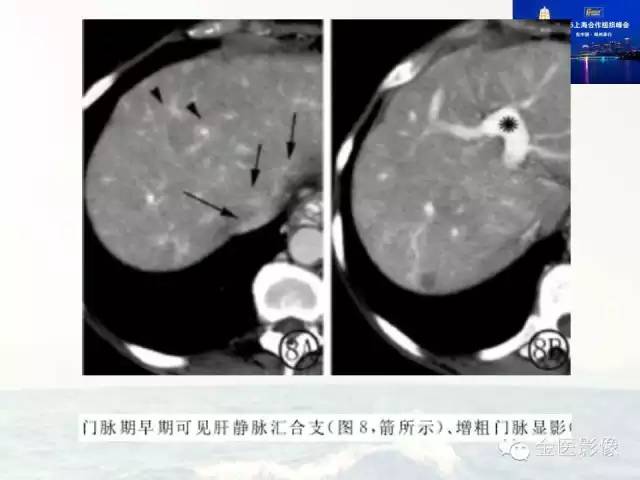 影像PPT - 【PPT】遗传性毛细血管扩张症的临床及影像诊断-17