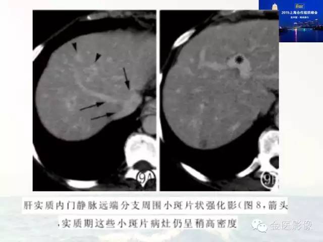 影像PPT - 【PPT】遗传性毛细血管扩张症的临床及影像诊断-18