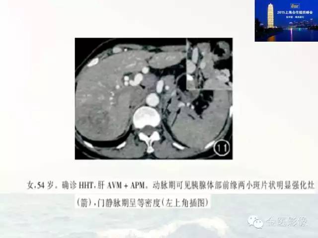 影像PPT - 【PPT】遗传性毛细血管扩张症的临床及影像诊断-20