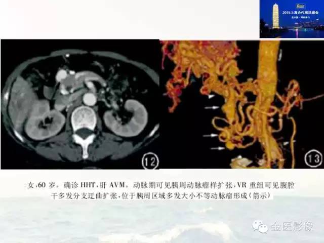 影像PPT - 【PPT】遗传性毛细血管扩张症的临床及影像诊断-21