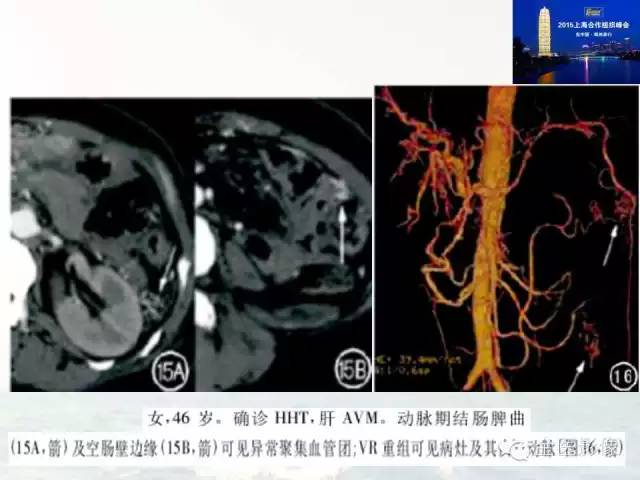 影像PPT - 【PPT】遗传性毛细血管扩张症的临床及影像诊断-23