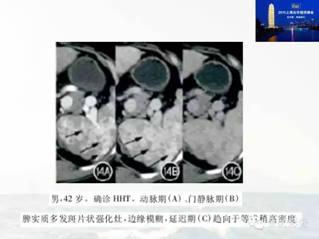 影像PPT - 【PPT】遗传性毛细血管扩张症的临床及影像诊断-25