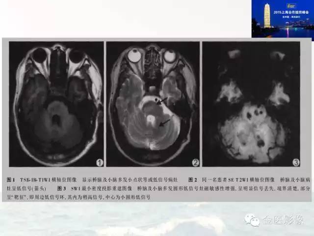 影像PPT - 【PPT】遗传性毛细血管扩张症的临床及影像诊断-33