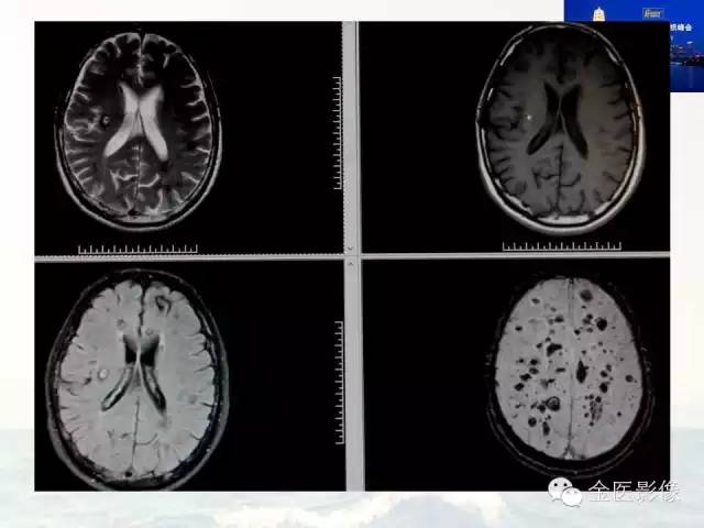 影像PPT - 【PPT】遗传性毛细血管扩张症的临床及影像诊断-36