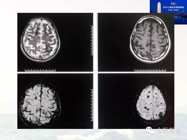 影像PPT - 【PPT】遗传性毛细血管扩张症的临床及影像诊断-37