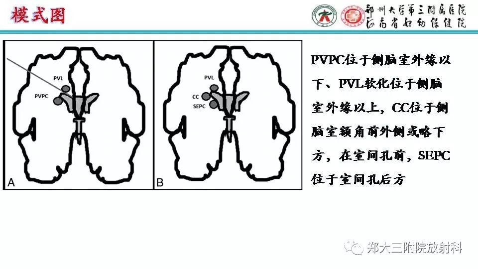 影像PPT - 【PPT】室周假性囊肿-6