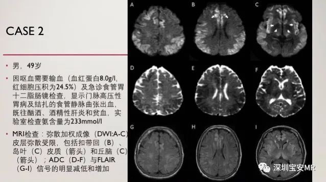 影像PPT - 急性高氨血症脑病的影像表现-2