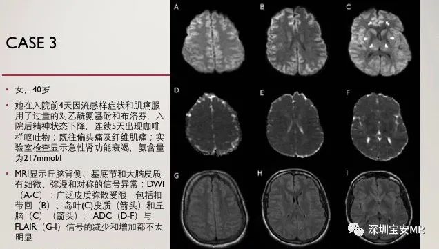 影像PPT - 急性高氨血症脑病的影像表现-3