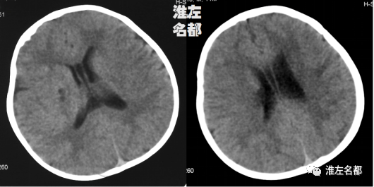 影像PPT - 【病例】婴儿外伤后基底节梗死1例CT及MR-1 影像PPT - 【病例】婴儿外伤后基底节梗死1例CT及MR-1