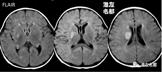 影像PPT - 【病例】婴儿外伤后基底节梗死1例CT及MR-3 影像PPT - 【病例】婴儿外伤后基底节梗死1例CT及MR-3