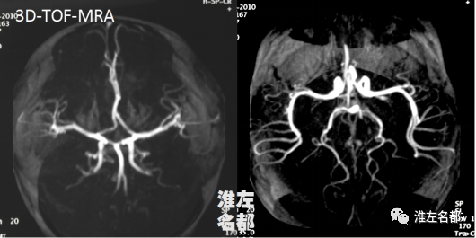 影像PPT - 【病例】婴儿外伤后基底节梗死1例CT及MR-4 影像PPT - 【病例】婴儿外伤后基底节梗死1例CT及MR-4