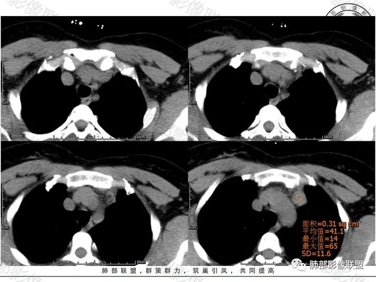 影像PPT - 【病例】前纵隔富血供占位—甲状腺癌1例CT鉴别诊断-2 影像PPT - 【病例】前纵隔富血供占位—甲状腺癌1例CT鉴别诊断-2