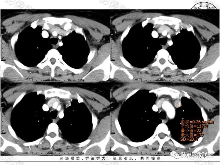 影像PPT - 【病例】前纵隔富血供占位—甲状腺癌1例CT鉴别诊断-4 影像PPT - 【病例】前纵隔富血供占位—甲状腺癌1例CT鉴别诊断-4