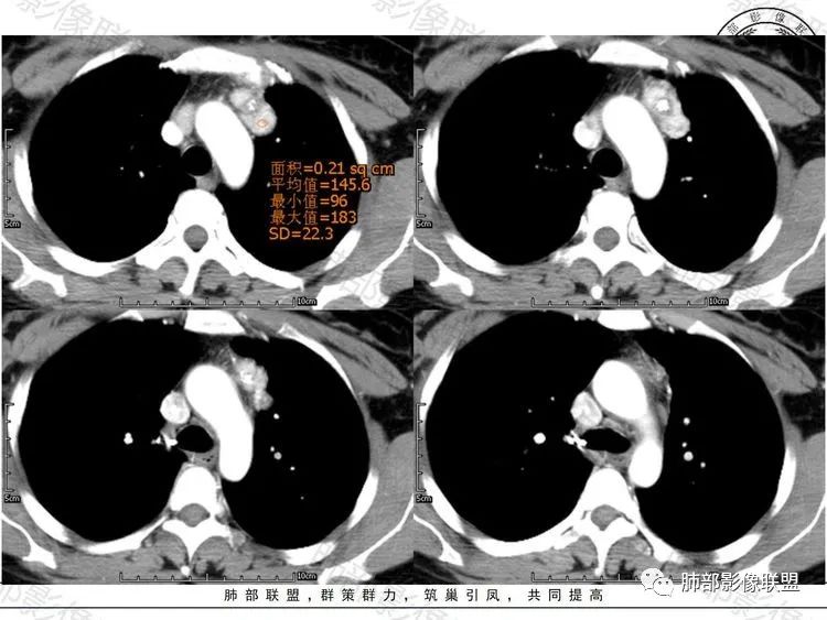 影像PPT - 【病例】前纵隔富血供占位—甲状腺癌1例CT鉴别诊断-5 影像PPT - 【病例】前纵隔富血供占位—甲状腺癌1例CT鉴别诊断-5