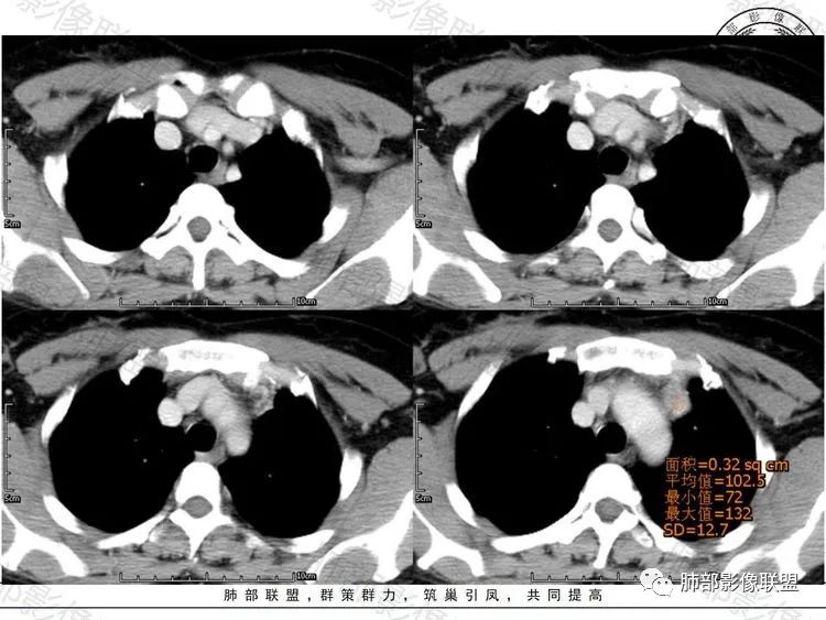 影像PPT - 【病例】前纵隔富血供占位—甲状腺癌1例CT鉴别诊断-6 影像PPT - 【病例】前纵隔富血供占位—甲状腺癌1例CT鉴别诊断-6