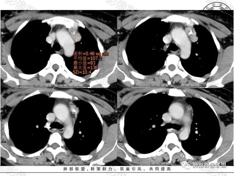 影像PPT - 【病例】前纵隔富血供占位—甲状腺癌1例CT鉴别诊断-7 影像PPT - 【病例】前纵隔富血供占位—甲状腺癌1例CT鉴别诊断-7