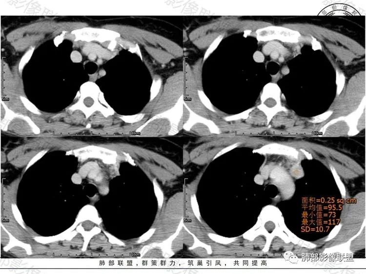 影像PPT - 【病例】前纵隔富血供占位—甲状腺癌1例CT鉴别诊断-8 影像PPT - 【病例】前纵隔富血供占位—甲状腺癌1例CT鉴别诊断-8