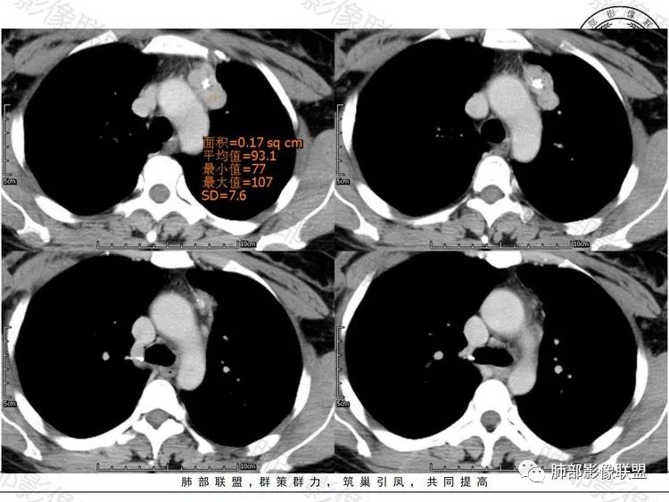影像PPT - 【病例】前纵隔富血供占位—甲状腺癌1例CT鉴别诊断-9 影像PPT - 【病例】前纵隔富血供占位—甲状腺癌1例CT鉴别诊断-9