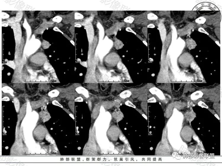 影像PPT - 【病例】前纵隔富血供占位—甲状腺癌1例CT鉴别诊断-10 影像PPT - 【病例】前纵隔富血供占位—甲状腺癌1例CT鉴别诊断-10