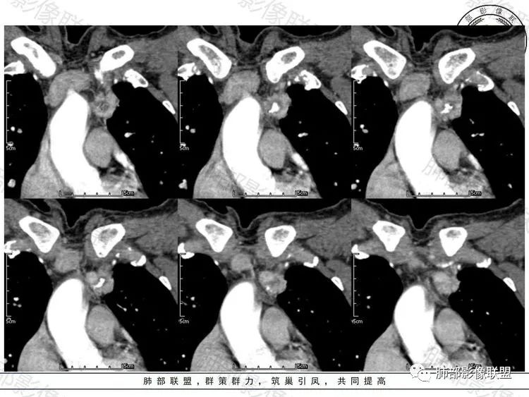 影像PPT - 【病例】前纵隔富血供占位—甲状腺癌1例CT鉴别诊断-11 影像PPT - 【病例】前纵隔富血供占位—甲状腺癌1例CT鉴别诊断-11