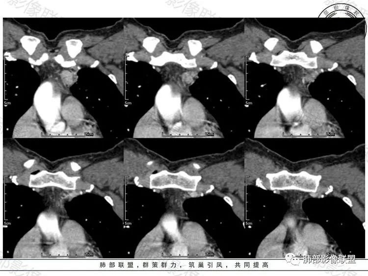 影像PPT - 【病例】前纵隔富血供占位—甲状腺癌1例CT鉴别诊断-12 影像PPT - 【病例】前纵隔富血供占位—甲状腺癌1例CT鉴别诊断-12