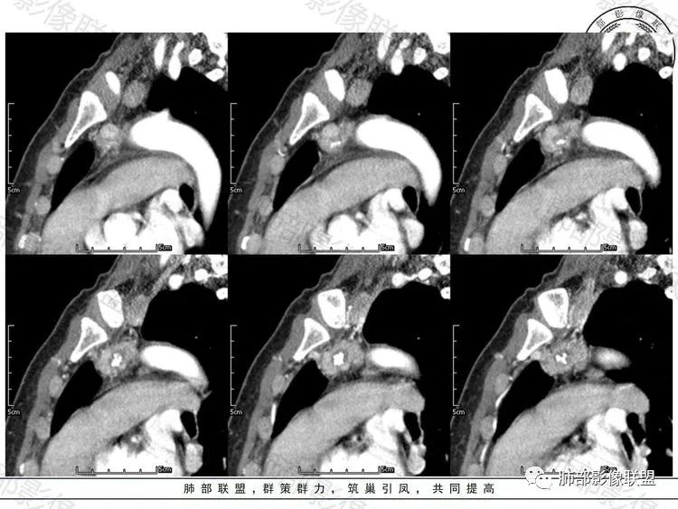 影像PPT - 【病例】前纵隔富血供占位—甲状腺癌1例CT鉴别诊断-13 影像PPT - 【病例】前纵隔富血供占位—甲状腺癌1例CT鉴别诊断-13