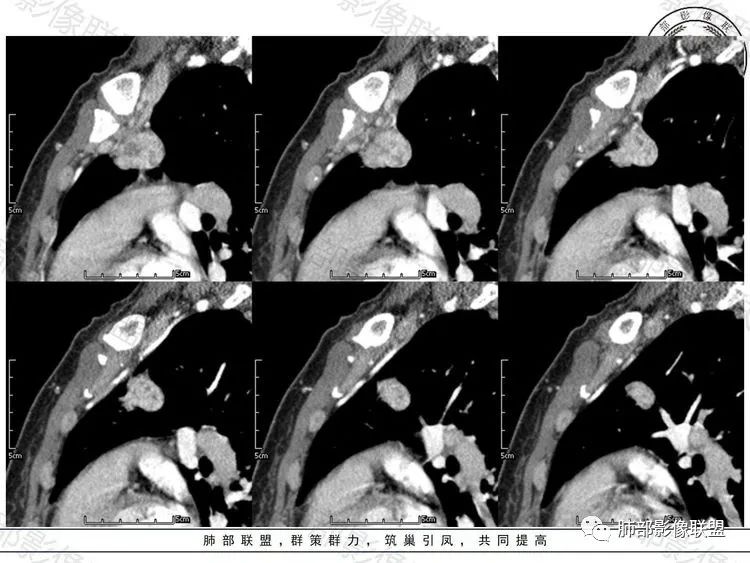 影像PPT - 【病例】前纵隔富血供占位—甲状腺癌1例CT鉴别诊断-14 影像PPT - 【病例】前纵隔富血供占位—甲状腺癌1例CT鉴别诊断-14