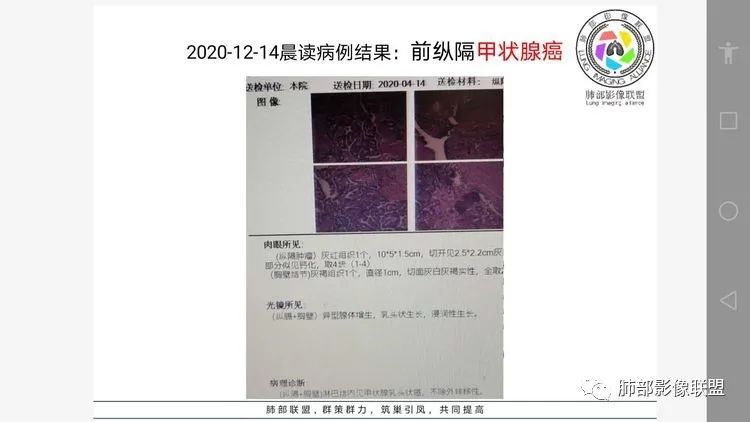 影像PPT - 【病例】前纵隔富血供占位—甲状腺癌1例CT鉴别诊断-15 影像PPT - 【病例】前纵隔富血供占位—甲状腺癌1例CT鉴别诊断-15