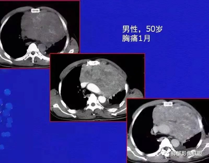 影像PPT - 【病例】前纵隔富血供占位—甲状腺癌1例CT鉴别诊断-25 影像PPT - 【病例】前纵隔富血供占位—甲状腺癌1例CT鉴别诊断-25