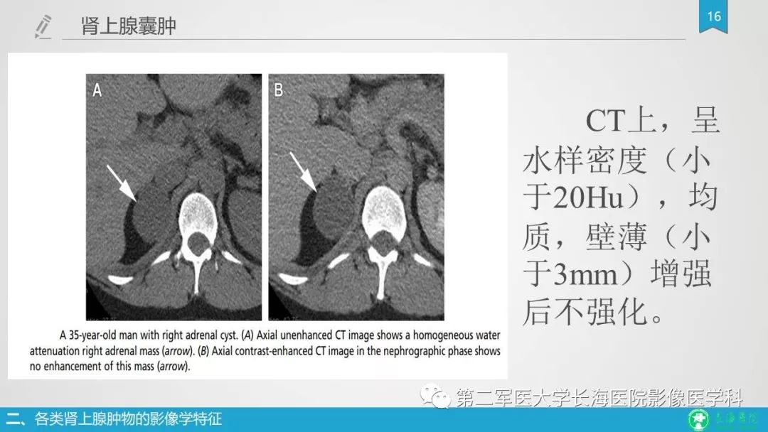 影像PPT - 【PPT】肾上腺肿物的分类及其影像学特点-16 影像PPT - 【PPT】肾上腺肿物的分类及其影像学特点-16