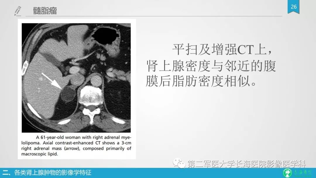 影像PPT - 【PPT】肾上腺肿物的分类及其影像学特点-26 影像PPT - 【PPT】肾上腺肿物的分类及其影像学特点-26