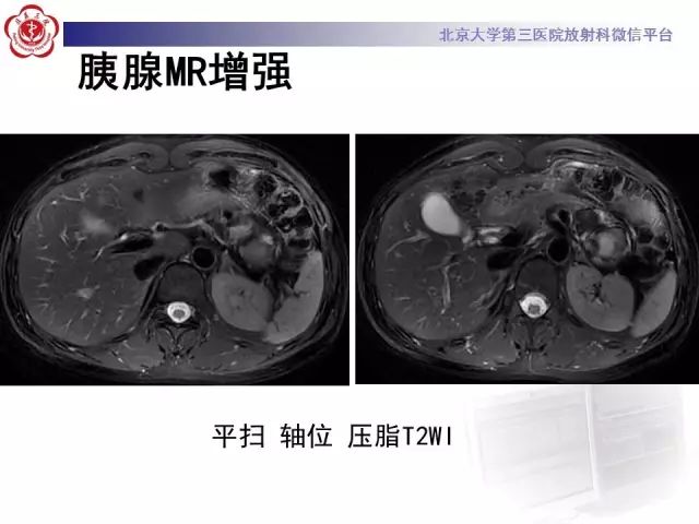 影像PPT - 【PPT】胰腺实性假乳头状肿瘤的影像-8