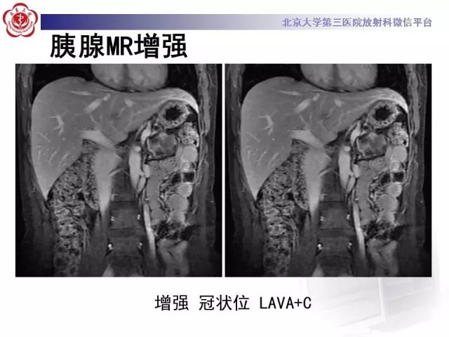 影像PPT - 【PPT】胰腺实性假乳头状肿瘤的影像-12