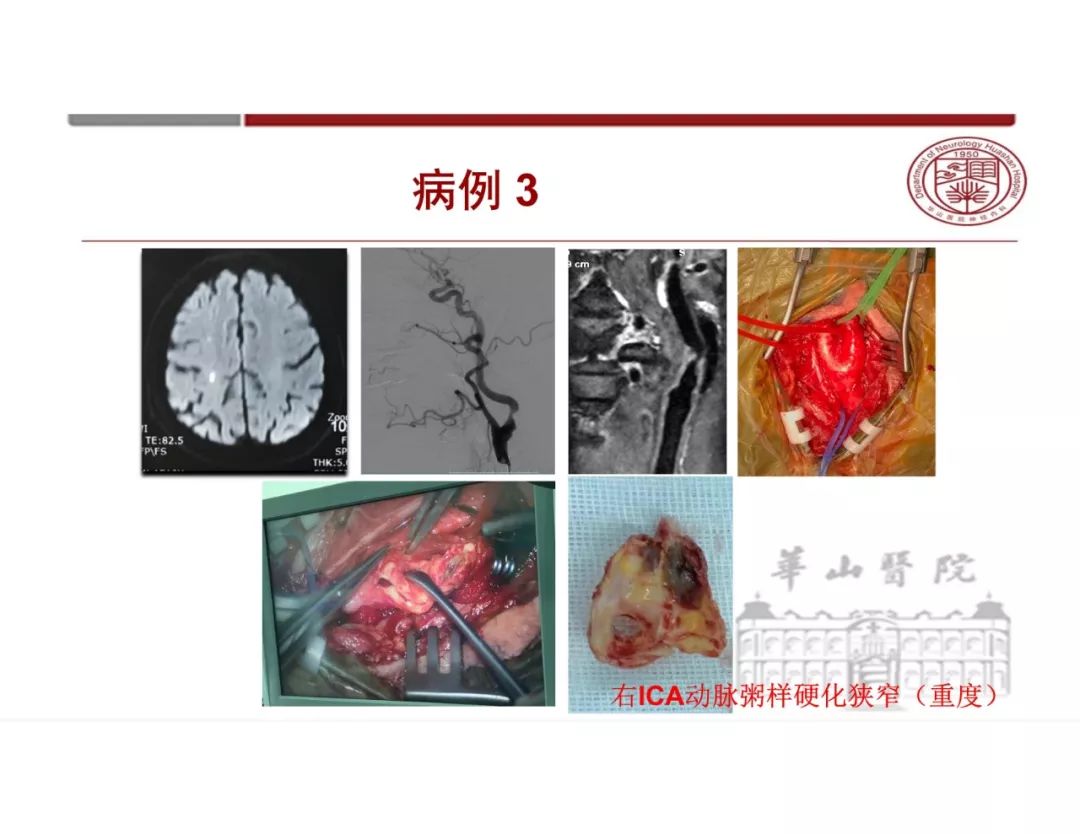 影像PPT - 【PPT】脑血管的解剖基础-11