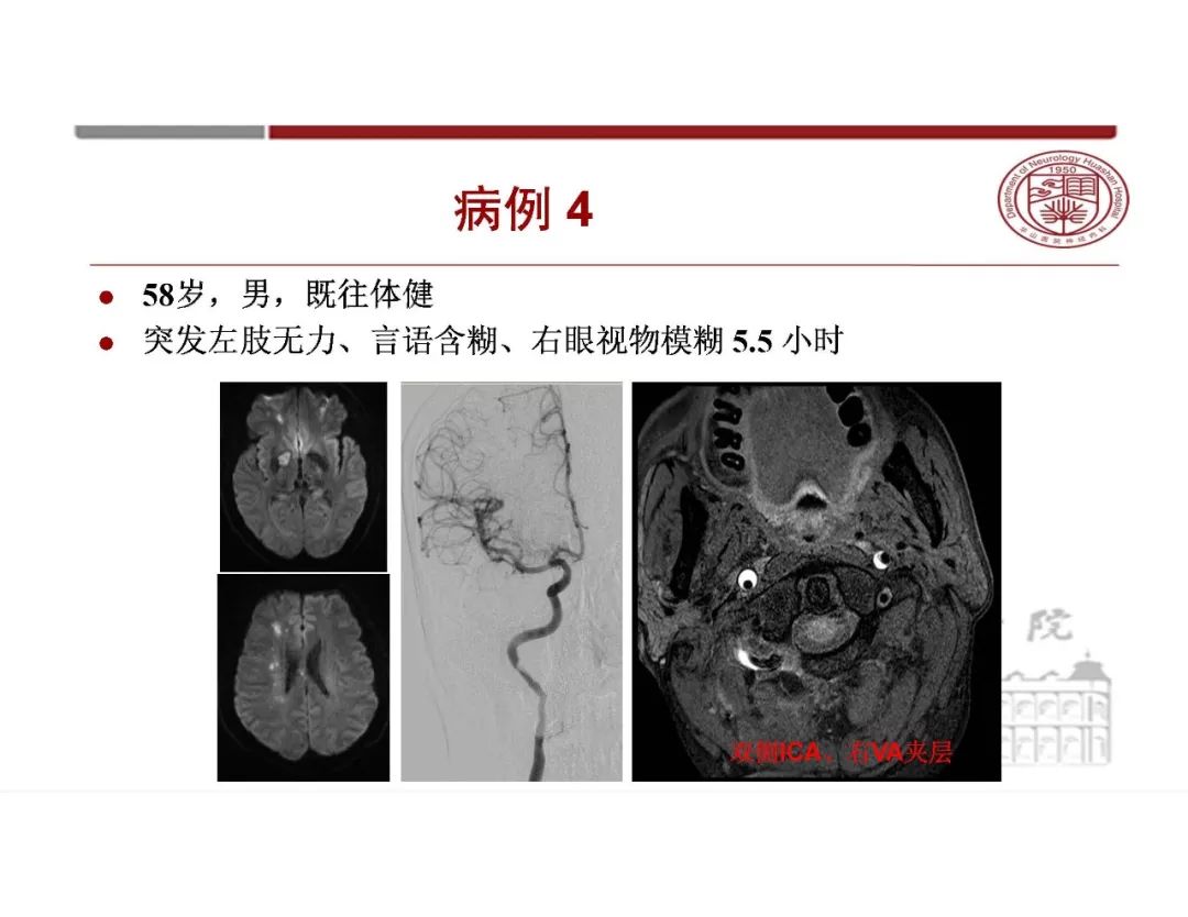 影像PPT - 【PPT】脑血管的解剖基础-12