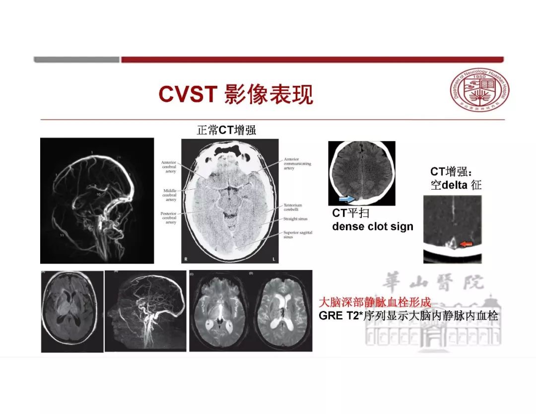 影像PPT - 【PPT】脑血管的解剖基础-44