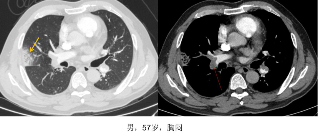 影像PPT - 晕征—相关呼吸系统疾病的影像表现与机制-22 影像PPT - 晕征—相关呼吸系统疾病的影像表现与机制-22