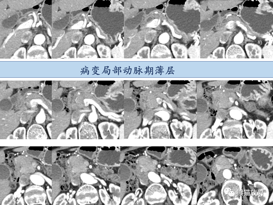 影像PPT - 【病例】IgG4相关硬化性胆管炎及肾炎2例-7